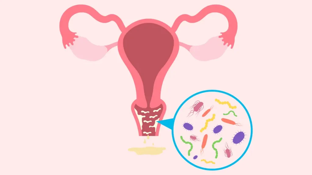 vaginite com representação de bactérias na região vaginal