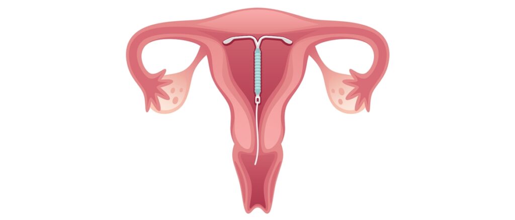 diu uterina