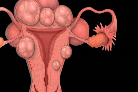 miomas uterinas