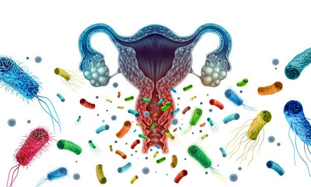 Ilustração dos principais tipos de vaginite: vaginose bacteriana, candidíase e tricomoníase.