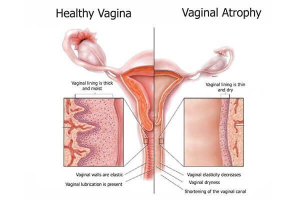 Texto alternativo (alt text – acessibilidade e SEO) Ilustração comparativa entre vagina saudável e vagina com atrofia vaginal, mostrando diferenças na espessura da mucosa, lubrificação, elasticidade e estrutura do canal vaginal, com destaque para tecido espesso e úmido na condição saudável e tecido fino e ressecado na atrofia.