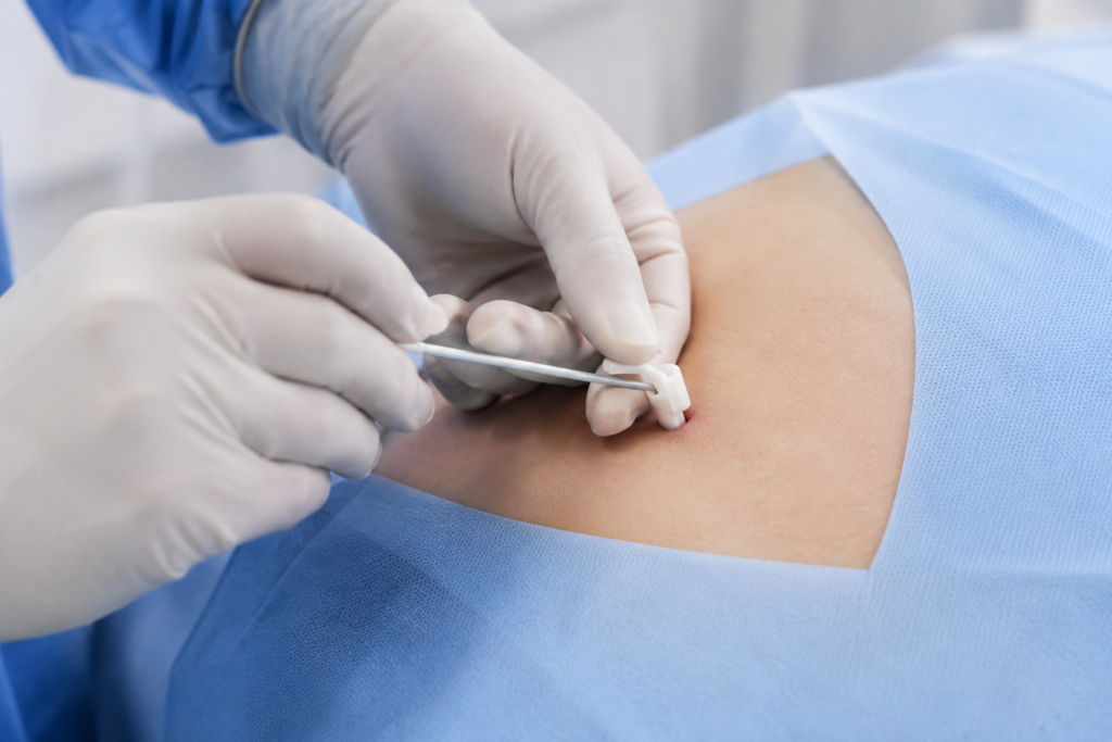 Procedimento de inserção do implante subcutâneo hormonal em consultório