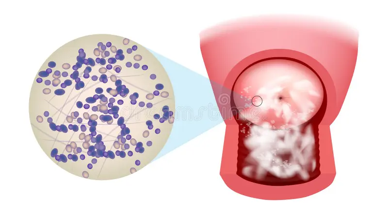 como diferenciar candidíase vaginose e infecção urinária
