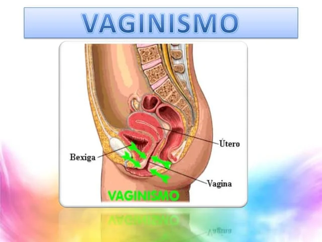Vaginismo: contração da musculatura vaginal