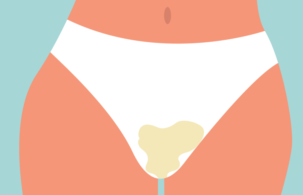 vaginose bacteriana sintomas corrimento com odor vaginal