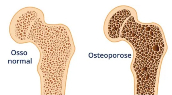 sarcopenia na menopausa